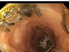 Staple Line Leak after Sleeve Gastrectomy