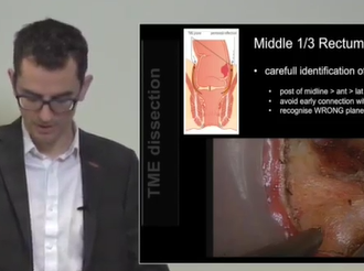 State of the Art Masterclass- Transanal Total Mesorectal Excision