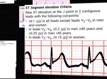 STelevation ECG Differential Diagnosis