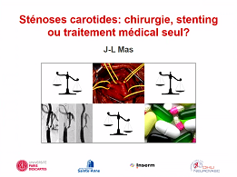 Stenoses des carotides : chirurgie, stenting ou traitement médical ? Stenoses des carotides : chirurgie, stenting ou traitement médical ?