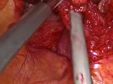 STEP BY STEP RIGHT COLECTOMY AND INTRACORPOREAL STAPLED SIDE-TO-SIDE ILEOCOLIC ANASTOMOSIS STEP BY STEP RIGHT COLECTOMY AND INTRACORPOREAL STAPLED SIDE-TO-SIDE ILEOCOLIC ANASTOMOSIS