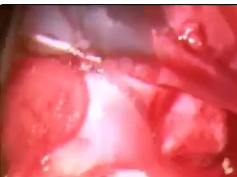 Step-by-Step Surgical Technique of Adjustable Nasal Transposition of the Split Nasal Lateral Rectus Step-by-Step Surgical Technique of Adjustable Nasal Transposition of the Split Nasal Lateral Rectus