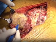 Sternal allograft transplantation for anterior chest wall reconstruction after sternectomy Sternal allograft transplantation for anterior chest wall reconstruction after sternectomy