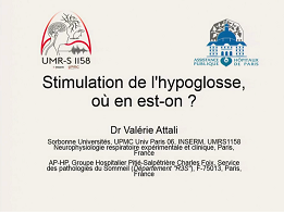 Stimulation de l'hypoglosse, où en est-on ?