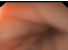 Stomach, Abnormal Post Surgical Anatomy, Acute Ugib Following PEG