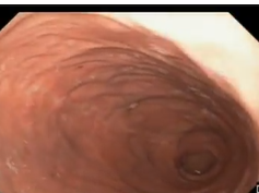 Stomach, Abnormal Post Surgical Anatomy, Dilated Sleeve Gastrectomy with Retained Fundus Stomach, Abnormal Post Surgical Anatomy, Dilated Sleeve Gastrectomy with Retained Fundus
