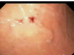 Stomach, Abnormal Post Surgical Anatomy, Gastric Ulcers Following Acute Early PEG Removal Stomach, Abnormal Post Surgical Anatomy, Gastric Ulcers Following Acute Early PEG Removal