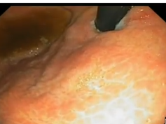 Stomach, Benign Conditions, Diffuse Stress Gastritis from Neurologic Injury