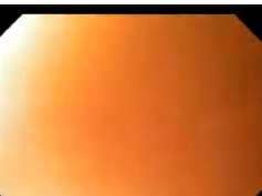 Stomach, Benign Findings, Hiatal Hernia