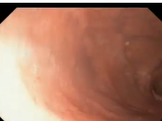 Stomach, Benign Findings, Submucosal Lesion, Pancreatic Rest