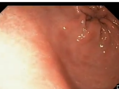 Stomach, Benign Tumors, Gastric Antral Vascular Ectasia