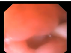 Stomach, Malignant Tumor, Adenocarcinoma with Gastric Outlet Obstruction