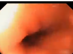 Stomach, Normal Post Surgical Anatomy, Depage-janeway Gastrostomy