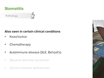 Stomatitis (Oral Mucositis) - Pediatric Infectious Diseases