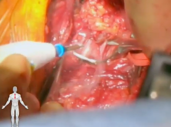 Subclavian Aneurysm Repair in Marfan's Syndrome Patient (Lumsden, MD; MacGillivray, MD; Zubair, MD) Subclavian Aneurysm Repair in Marfan's Syndrome Patient (Lumsden, MD; MacGillivray, MD; Zubair, MD)