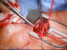 Subclavian-Brachial Bypass Subclavian-Brachial Bypass