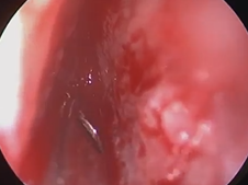 Submucosal Inferior Turbinate Reduction