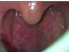 Submucosal Pulsatile Mass in the Right Retropharyngeal Space