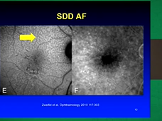 Subretinal Drusenoid Deposits & the ALSTAR Cohort