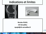 Substitution méniscale : indications et limites Substitution méniscale : indications et limites