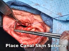 Subtotal Petrosectomy With Blind Sac Ear Canal Closure