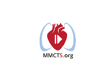 Subtotal pleurectomy by video-assisted thoracic surgery for metastatic pleuritis Subtotal pleurectomy by video-assisted thoracic surgery for metastatic pleuritis