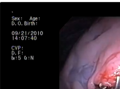 Subxiphoid Flexible Endoscopic Approach For Pulmonary Vein Dissection In An Acute Animal Model Subxiphoid Flexible Endoscopic Approach For Pulmonary Vein Dissection In An Acute Animal Model