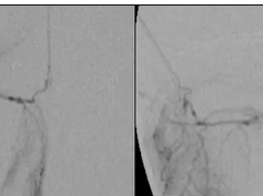 Success of Intra-arterial Chemotherapy (Chemosurgery) for Retinoblastoma: Effect of Orbitovascular A Success of Intra-arterial Chemotherapy (Chemosurgery) for Retinoblastoma: Effect of Orbitovascular A
