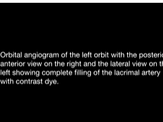 Success of Intra-arterial Chemotherapy (Chemosurgery) for Retinoblastoma: Effect of Orbitovascular A Success of Intra-arterial Chemotherapy (Chemosurgery) for Retinoblastoma: Effect of Orbitovascular A