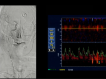 Successful TCAR After Failed Transfemoral Attempt Successful TCAR After Failed Transfemoral Attempt