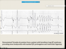 Sudden cardiac death and latest updates about it.