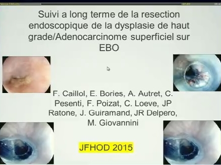 Suivi à long terme de la résection endoscopique de la dysplasie de haut grade/adénocarcinome superficiel sur endobrachyœsophage