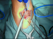 Superficial Femoral Artery to Dorsalis Pedis Artery Bypass Superficial Femoral Artery to Dorsalis Pedis Artery Bypass