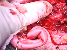 Superficial parotidectomy