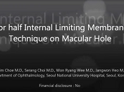 Superior Half Internal Limiting Membrane Flap Technique on Macular Hole Superior Half Internal Limiting Membrane Flap Technique on Macular Hole