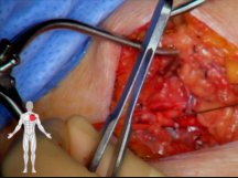 Superior Mesenteric Artery Stenting Superior Mesenteric Artery Stenting