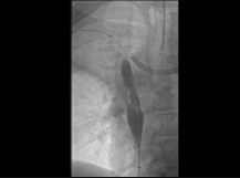 Superior Vena Cava Stenting Superior Vena Cava Stenting