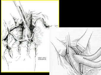Supra Celiac Aortic Exposure (ALAN B. LUMSDEN, MD) Supra Celiac Aortic Exposure (ALAN B. LUMSDEN, MD)