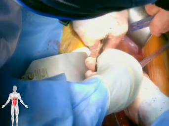 Supraceliac Aorta to Superior Mesenteric Artery Bypass (Alan B. Lumsden, MD, M. Mujeeb Zubair, MD) Supraceliac Aorta to Superior Mesenteric Artery Bypass (Alan B. Lumsden, MD, M. Mujeeb Zubair, MD)