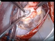 Surgery for subvalvar aortic stenosis resection of discrete subvalvar aortic membrane Surgery for subvalvar aortic stenosis resection of discrete subvalvar aortic membrane