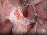 Surgery for tetralogy of Fallot  absent pulmonary valve syndrome