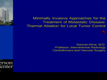 Surgical Management and Minimally Invasive Approaches for the Treatment of Metastatic Sarcoma 2 Surgical Management and Minimally Invasive Approaches for the Treatment of Metastatic Sarcoma 2