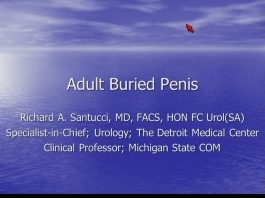 Traitement chirurgical du pénis enfoui chez l'adulte