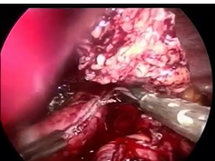 Surgical Options In Management Of Failed And Complicated Vertical Band Gastroplasty (Vbg): Laparosco Surgical Options In Management Of Failed And Complicated Vertical Band Gastroplasty (Vbg): Laparosco