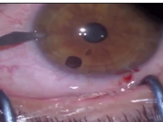 Surgical Removal Surgical Removal