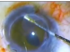 Surgical Steps to Manage Epithelial Ingrowth Surgical Steps to Manage Epithelial Ingrowth