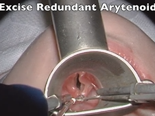 Suspension Laryngoscopy and Cold Steel Supraglottoplasty