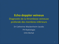 Suspicion de thrombose veineuse profonde : cas radio-clinique