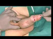 Suture-Free Sealing of Tunical Defect With Collagen Fleece