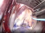 Suturing map for endoscopic mitral valve repair